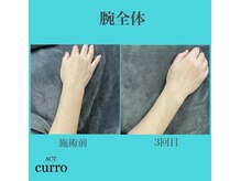 アクト クロ(ACT curro)/【腕全体】脱毛施術例