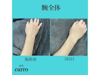 アクト クロ(ACT curro)/【腕全体】脱毛施術例
