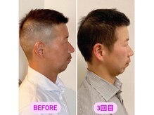 小顔22 ボルティ 赤坂支店(Bolty)/40代：小顔シンメトリー（3回）