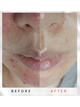 ホワイトアクア 福岡天神店(WHITE AQUA)/韓国の女医が開発したララピール