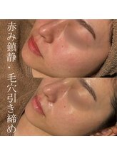 セレア(CELEA)/ハイドロ毛穴洗浄/毛穴引き締め