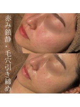 セレア(CELEA)/ハイドロ毛穴洗浄/毛穴引き締め