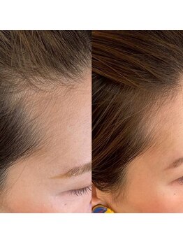 グラーティア(gratia)/プロセル育毛促進トリートメント