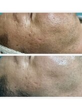 ウルオイ 海老名(URUoi)/ニキビや乾燥やくすみにも！