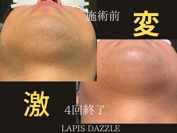ラピスダズル(LAPIS DAZZLE)/ヒゲ脱毛☆途中経過(4回終了)
