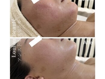 ルルボーテ(Loulou Beaute)/クリスティーナ/アンストレス