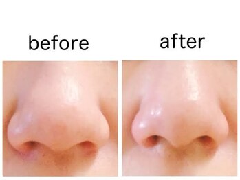 モイリープ(Moileep)/お鼻の浮腫も撃退!