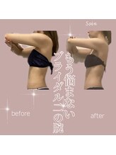 ソワン(Soin)/ブライダル背中 .二の腕集中