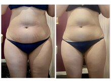 プリマヴェーラ(PRIMAVERA)/お腹&太もも&骨盤