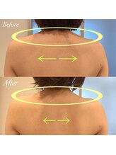 ルノン(Lunon)/肩甲骨はがし