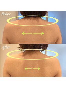 ルノン(Lunon)/肩甲骨はがし