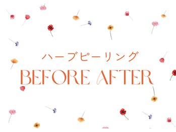 カイト(Kaito)/本気の肌質改善ハーブピーリング