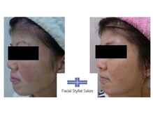 フェイシャルスタイリストサロン 高崎店(Facial Stylist Salon)/ケア例（45）