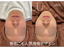 アルフォービューティー 恵比寿店(ALU for beauty)/HIRF LIFT症例