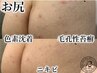 【リベル】ハーブピーリング2000円券付★《お尻》黒ずみ等￥22000(剥離あり)