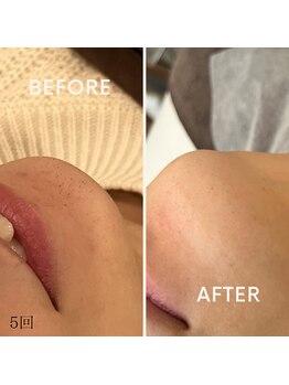 モアトゥインクル 山口店(MORE twinkle)/★症例写真★【30代】