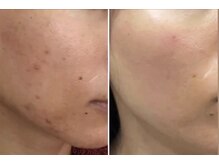 リメレ(Rimere)/プラズマ微細針スペシャルケア