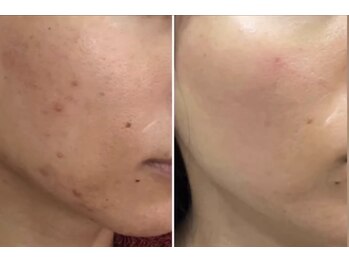 リメレ(Rimere)/プラズマ微細針スペシャルケア