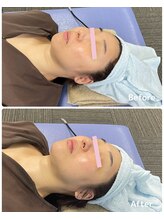 おおむら鍼灸接骨院/フェイシャル Before＆After