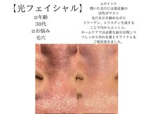 サロンツキ(salon tuki)/光フェイシャル症例/徳島/毛穴