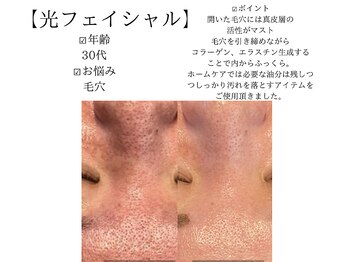 サロンツキ(salon tuki)/光フェイシャル症例/徳島/毛穴