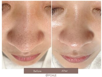 ポアレ 高崎店(POALE)/毛穴ケア症例【群馬/高崎】