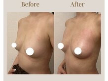 リネア(Linea)の雰囲気（1回でもバージスライン（下乳）にこの変化♪）