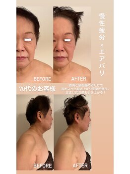 アンミー(anmiiy)/70代エアバリ変化/首肩頭