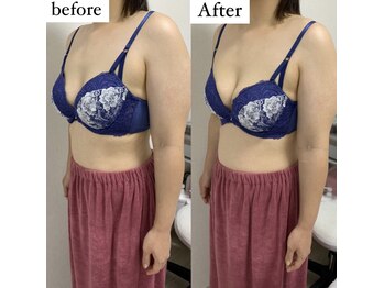 エムエム(mm)/2人出産30代女性/産後バスト