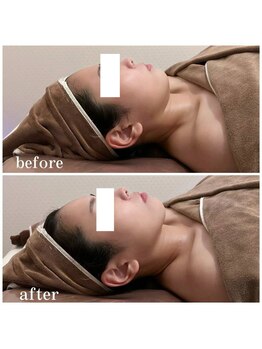 ミツレイ 九条店(MITUREI)/小顔