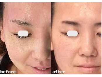 ミエリア美容鍼灸院(mielia美容鍼灸院)/幹細胞上澄液×マイクロニードル