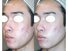 岩川治療院/ニキビケア＆リフトアップ♪