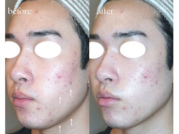 岩川治療院/ニキビケア&リフトアップ♪