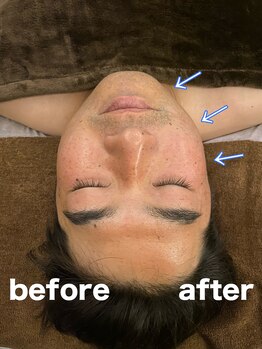 ルネミア(LuNemia)/施術