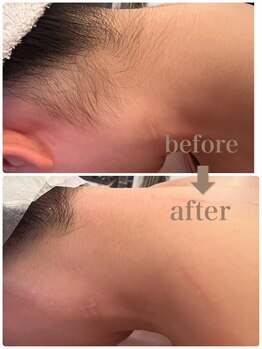 ラシュシュ(La Chou Chou)/◇都度払い脱毛◇