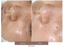 ポアレ 高崎店(POALE)/毛穴ケア症例【群馬/高崎】