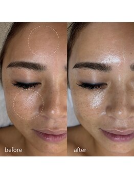 リディエイト(radiate.)/施術 : スキンメイド1回