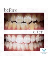 ホワイトニングショップ 広島店(WHITENING SHOP)/【ホワイトニング】Before After