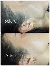 ビオトーン バイ ツリー(biotone by TREE)/フェイシャルワックス/Wax脱毛