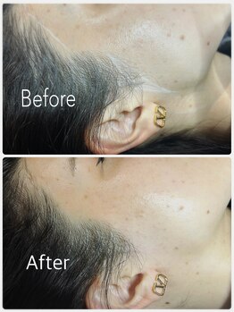 ビオトーン バイ ツリー(biotone by TREE)/フェイシャルワックス/Wax脱毛