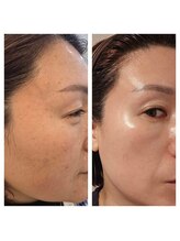 ユニ(Uni)/インセルダム使用例