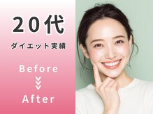 スロース鍼灸整体院(SLOTH鍼灸整体院)/20代 ダイエットBefore/After
