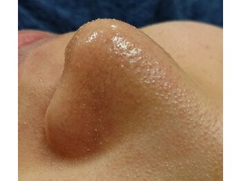 エステティックサロンアネラ(Anela)/毛穴吸引でしっかり汚れをケア