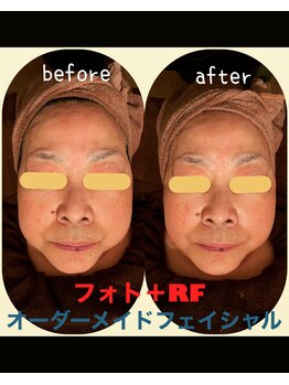 エルア(2 elua)/光＋RFフェイシャル