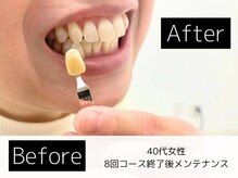 ホワイトニングカフェ 葛西店(WhiteningCafe)/◎歯のホワイトニング施術写真◎