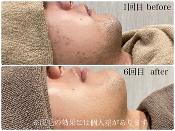 コモレビ(comorebi)/顔周り脱毛（経過画像）