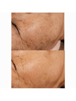 ウル バイ ラシック(Ulu by Lasic)/ララピール×ヒト幹細胞×フォト