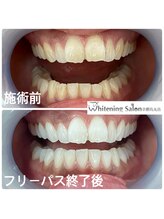 ホワイトニングサロン 京都烏丸店/ホワイトニング施術例
