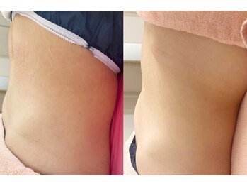 れふぇるん 足利店/40代 腸もみ 施術2回