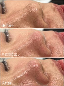 ジョアアンジェ 京橋店(joie ange)/毛穴ケア